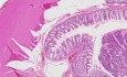 Gruczolakorak - histopatologia - okrężnica