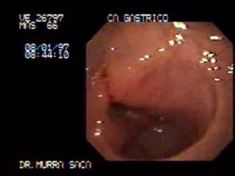 Gruczolakorak żołądka - niedrożność - endoskopia