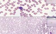 Układ krwiotwórczy - ostra białaczka