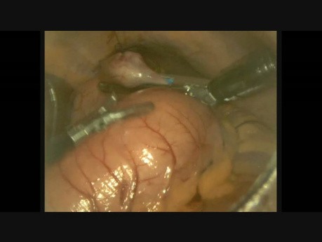GIST żołądka - laparoskopia 