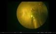  Enukleacja prostaty laserem GreenLight 
