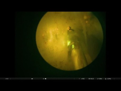  Enukleacja prostaty laserem GreenLight 