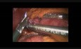 Bypass żołądka-zespolenie Roux-en-Y z techniką podwójnej pętli