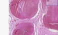 Organizacja zakrzepu - histopatologia prostaty, naczynia krwionośne