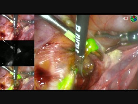 Procedura SLNB w przypadku raka endometrium