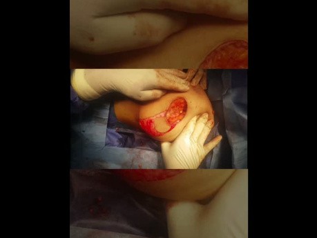 Plastyka Grisotti w chorobie Pageta z guzem otoczki brodawki sutkowej