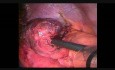 Martwica żołądka w przepuklinie rozworu przełykowego u pacjenta z opaską żołądkową