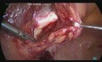 Całkowita laparoskopowa histerektomia wraz z pektopeksją z powodu wypadania narządu rodnego