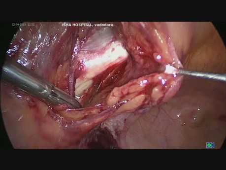 Całkowita laparoskopowa histerektomia wraz z pektopeksją z powodu wypadania narządu rodnego