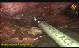 Torako-laparoskopowe usunięcie przełyku i śródpiersiowa limfadenektomia 