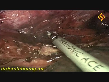 Torako-laparoskopowe usunięcie przełyku i śródpiersiowa limfadenektomia 