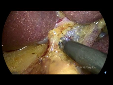 Całkowita laparoskopowa gastrektomia z limfadenetkomią D2