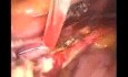 Kontrola krwawienia z tętnicy macicznej w trakcie histerektomii