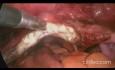 Laparoskopowa waginoplastyka z użyciem techniki przeciągania otrzewnej ("Pull Through Technique")