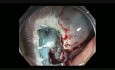 Komplikacje mukozektomii endoskopowej (EMR) - krwawienie z wstępnicy - przypadek 1B