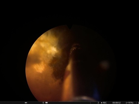Standardowa fotowaporyzacja prostaty z użyciem lasera GreenLight