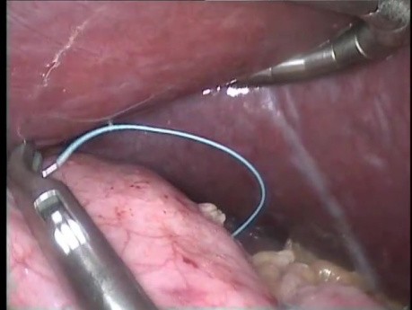 Chirurgia bariatryczna - laparoskopowe zastosowanie nowatorskiej metody 