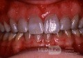 Przebarwienie zębów po tetracyklinach