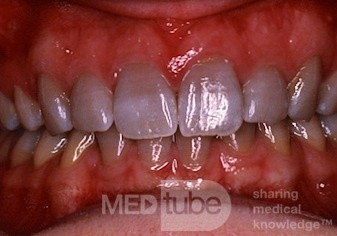 Przebarwienie zębów po tetracyklinach
