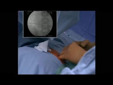 Endoskopowa dyscektomia kręgosłupa w odcinku lędźwiowym - dostęp transforaminlany