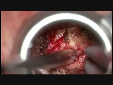 Foraminotomia i microdiscectomia szyjna C7/Th1 lewostronna z dostępu tylnego