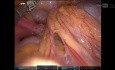 Robotyczna operacja endometriozy głęboko naciekającej