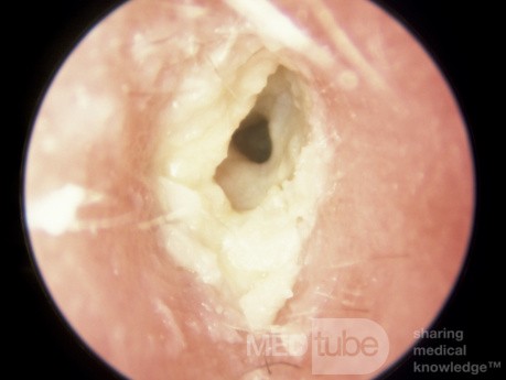 Przewlekłe zapalenie ucha zewnętrznego z widocznymi warstwami nieoddzielonej  zrogowaciałej keratyny
