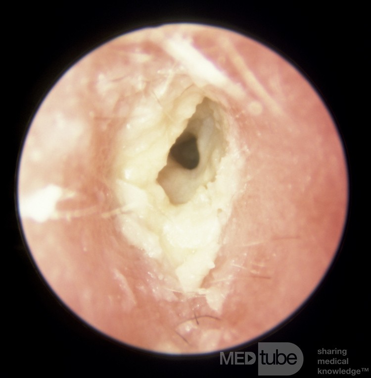 Przewlekłe zapalenie ucha zewnętrznego z widocznymi warstwami nieoddzielonej  zrogowaciałej keratyny