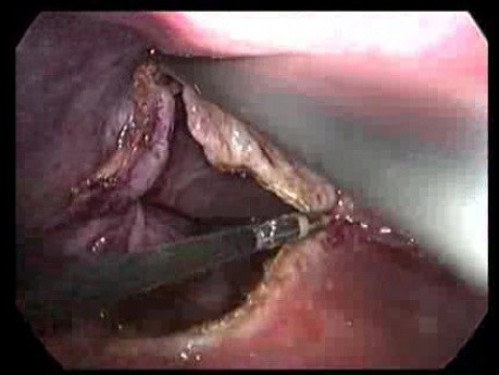 Torbiel prosta wątroby - laparoskopia - deroofing