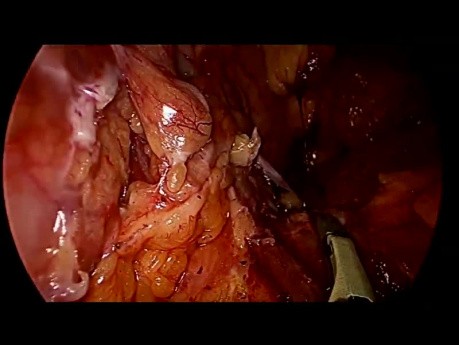 Dystalna pankreatektomia z powodu nowotworu (SPT) z oszczędzeniem śledziony metodą laparoskopową