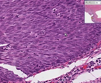 Szyjka macicy - metaplazja płaskonabłonkowa, rak in-situ
