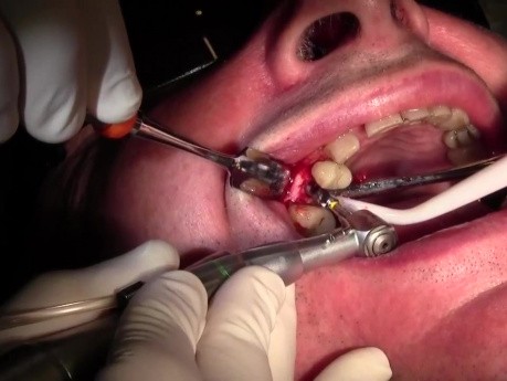 Wprowadzenie implantu po przeprowadzeniu sterowanej regeneracji kości - #4