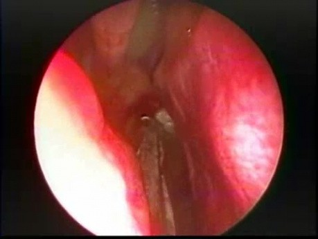 Endoskopowe usunięcie dużego polipa nozdrzy tylnych