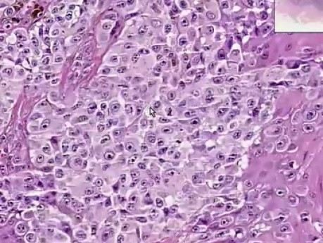 Czerniak złośliwy - histopatologia skóry