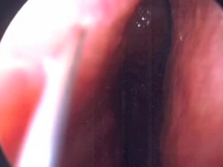 Endoskopowa plastyka przegrody - wideo z zabiegu