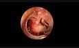 Badanie endoskopowe ucha środkowego