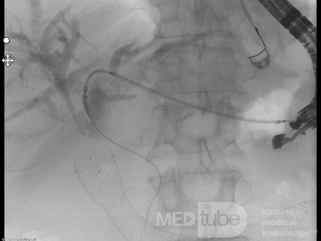 Endoskopowa hepaticogastrostomia pod kontrolą EUS [6/10]