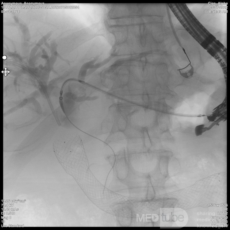 Endoskopowa hepaticogastrostomia pod kontrolą EUS [6/10]