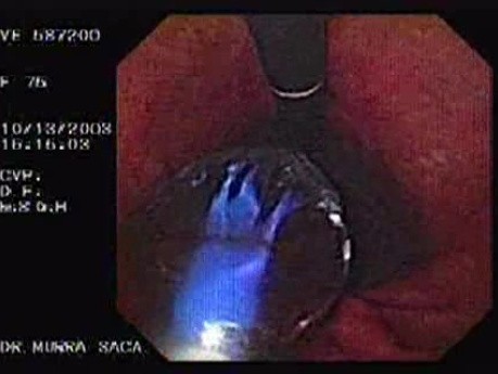 Achalazja - balon w widoku odwróconym (inwersja endoskopowa)