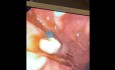 Endoskopowa resekcja śluzówki połączenia żołądkowo-przełykowego z powodu dysplastycznego guza