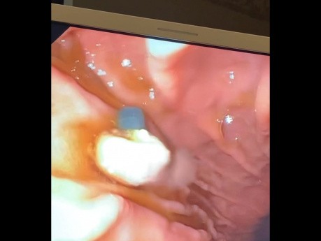Endoskopowa resekcja śluzówki połączenia żołądkowo-przełykowego z powodu dysplastycznego guza