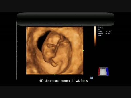 Prawidłowy płód w 11. tygodniu ciąży - USG 4D