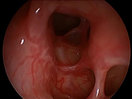 Wygląd jamy nosowej po przebytej funkcjonalnej endoskopowej operacji zatok