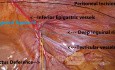 Landmarks in Laparoscopic TAPP Hernia Exploration