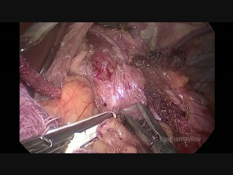 Laparoskopowa fundoplikacja sposobem Dor z miotomią sposobem Hellera z powodu achalazji przełyku