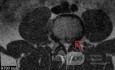 Microdiscectomía Lumbar