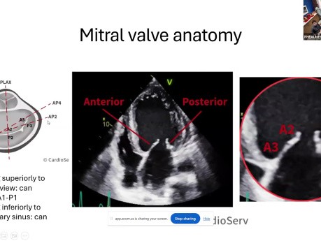 Podstawy anatomii zastawki mitralnej oraz diagnostyki obrazowej przed zabiegiem przezcewnikowej naprawy zastawki mitralnej techniką TEER