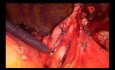 Jednoczasowa lobektomia górna prawostronna i tymektomia z dojścia podmostkowego