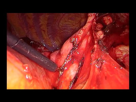 Jednoczasowa lobektomia górna prawostronna i tymektomia z dojścia podmostkowego