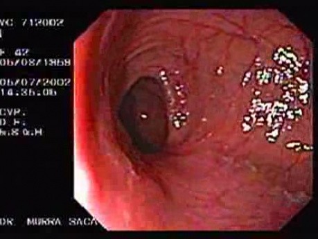 Choroba Leśniowskiego - Crohna - endoskopia (25 z 28)
